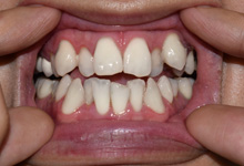 a close-up of a patient with crowded teeth