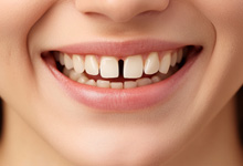 a close-up of a patient with a gap between their front teeth