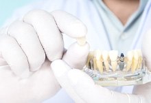 Dentist wearing white gloves holding model dental implant