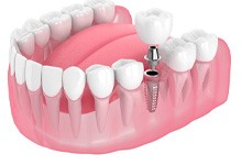 Rendering of a single dental implant and crown in a lower arch