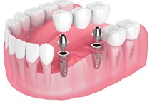 Rendering of a dental bridge anchored by 2 dental implants