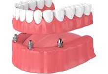Rendering of full dentures anchored by 4 dental implants